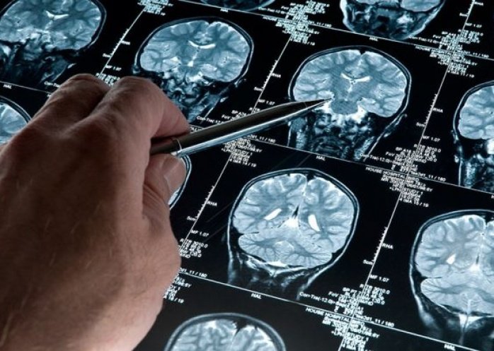 foto: La esperanza contra el Alzheimer, condicionada por los efectos secundarios del nuevo fármaco
